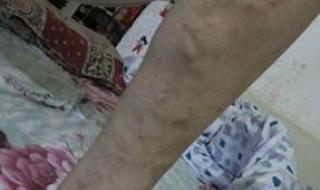 艾滋病的早期症状图片 艾滋病的早期症状图片